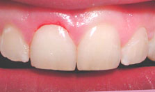 after gingivectomy