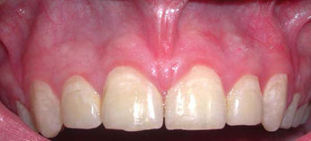 After Frenectomy