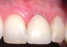 with dental implant