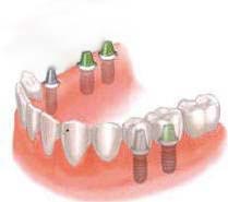 multiple tooth implants