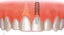 Dental implant placement