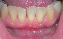After Frenectomy