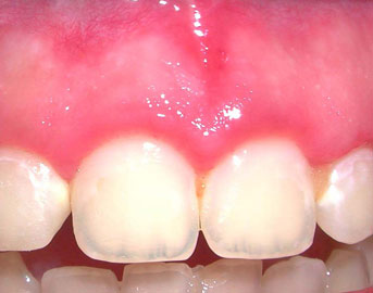 After Frenectomy