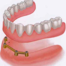 Denture retained to a bar