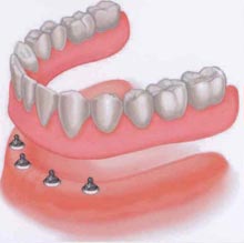 Denture w/O-ring attachments