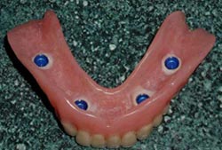 Denture with attachments