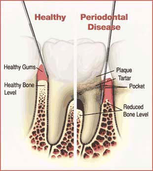 Periodontal Disease Chart