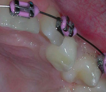 Retained Primary tooth with unerupted tooth