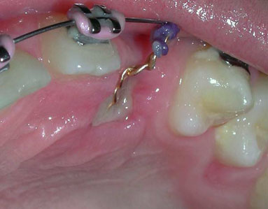 Gold chain bonded to unerupted tooth